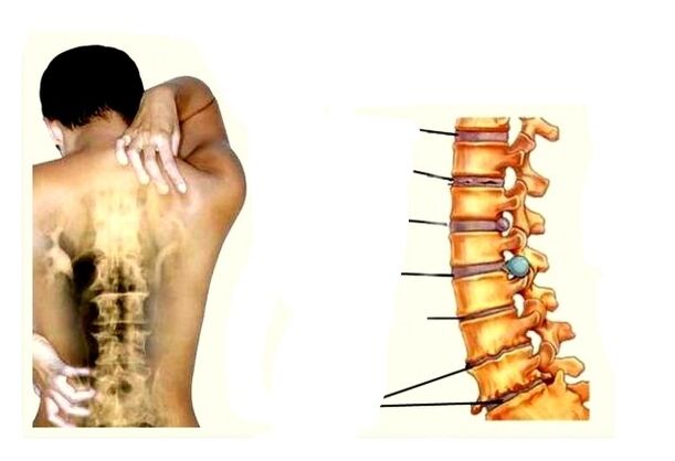 Osteochondrozės vystymosi etapai