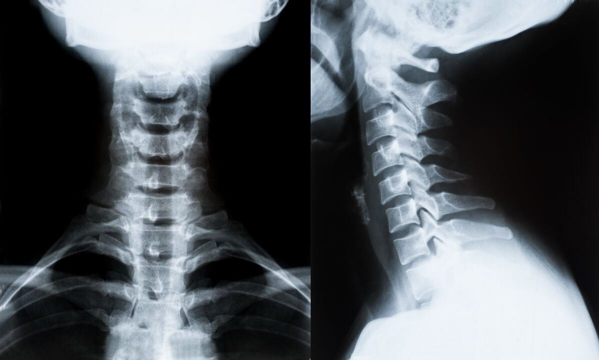 Gimdos kaklelio osteochondrozė rentgeno spinduliuose