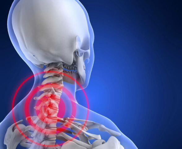 kaklo stuburo osteochondrozė
